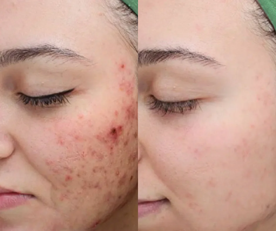 a woman with acne on her face