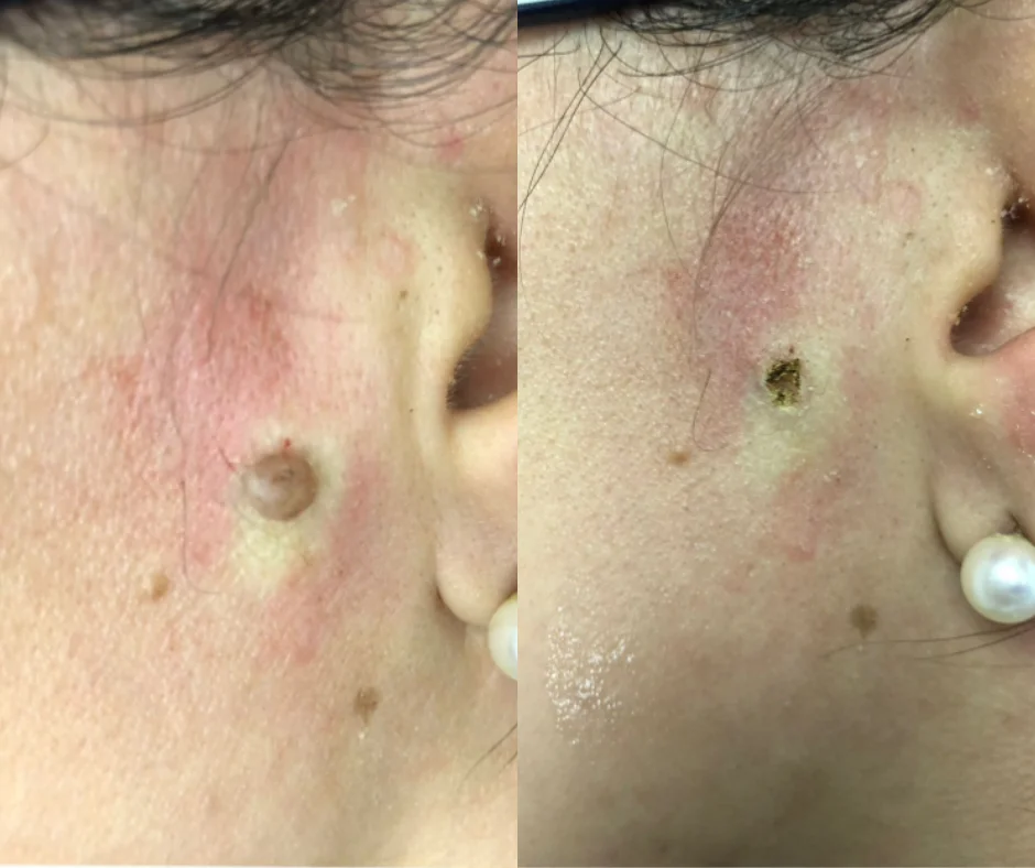 a person's face with a mole