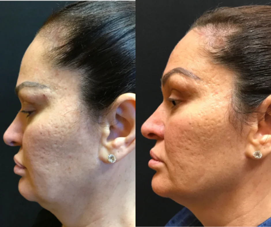 a woman's face before and after a procedure