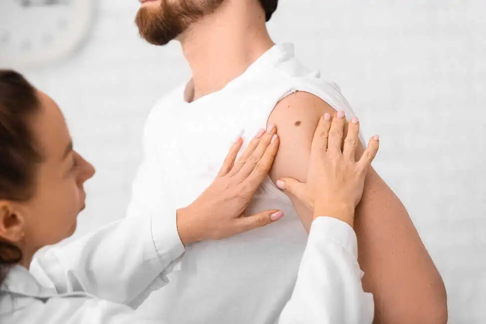 Mole Removal by MedSpa California in San Ramon, CA