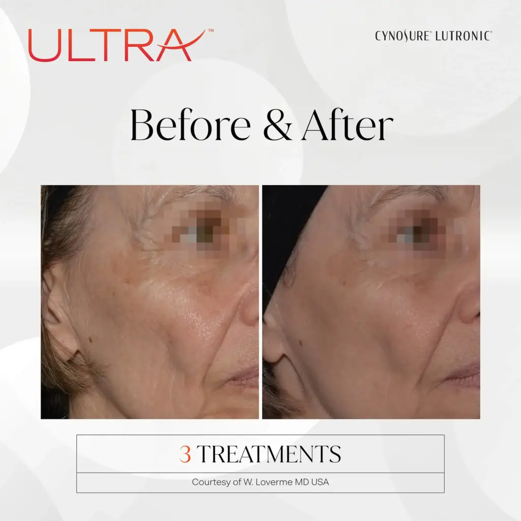 lasermd ultra before after five by medspa ca