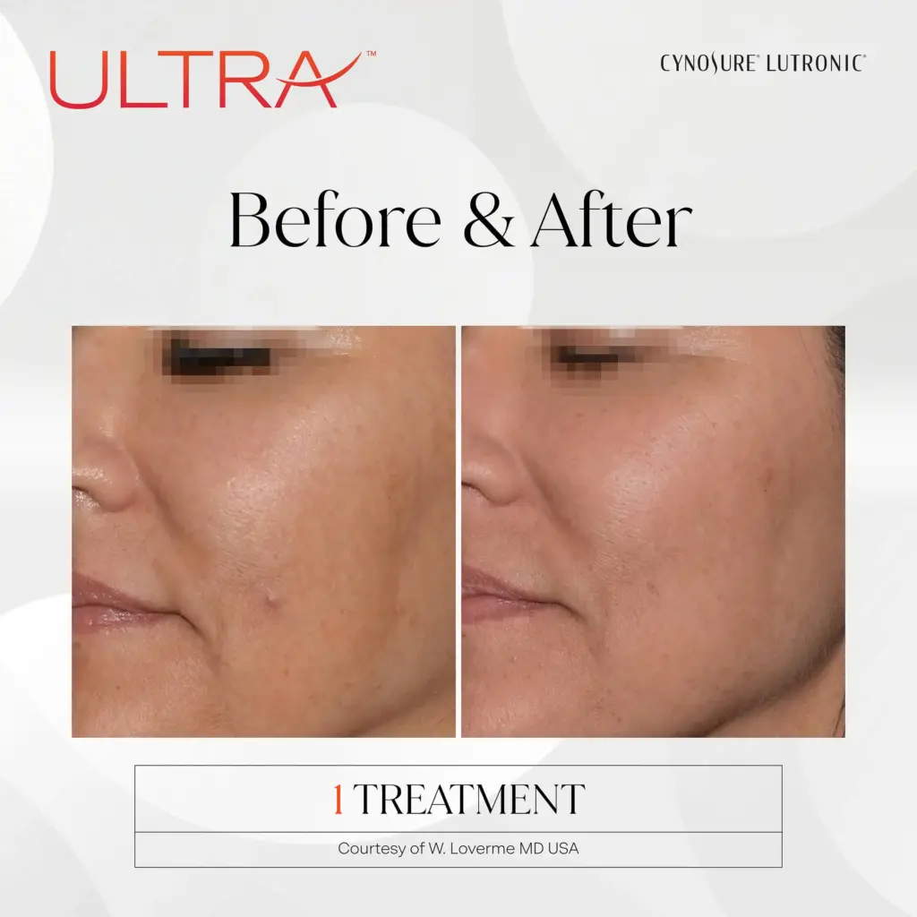 lasermd ultra before after four by medspa ca