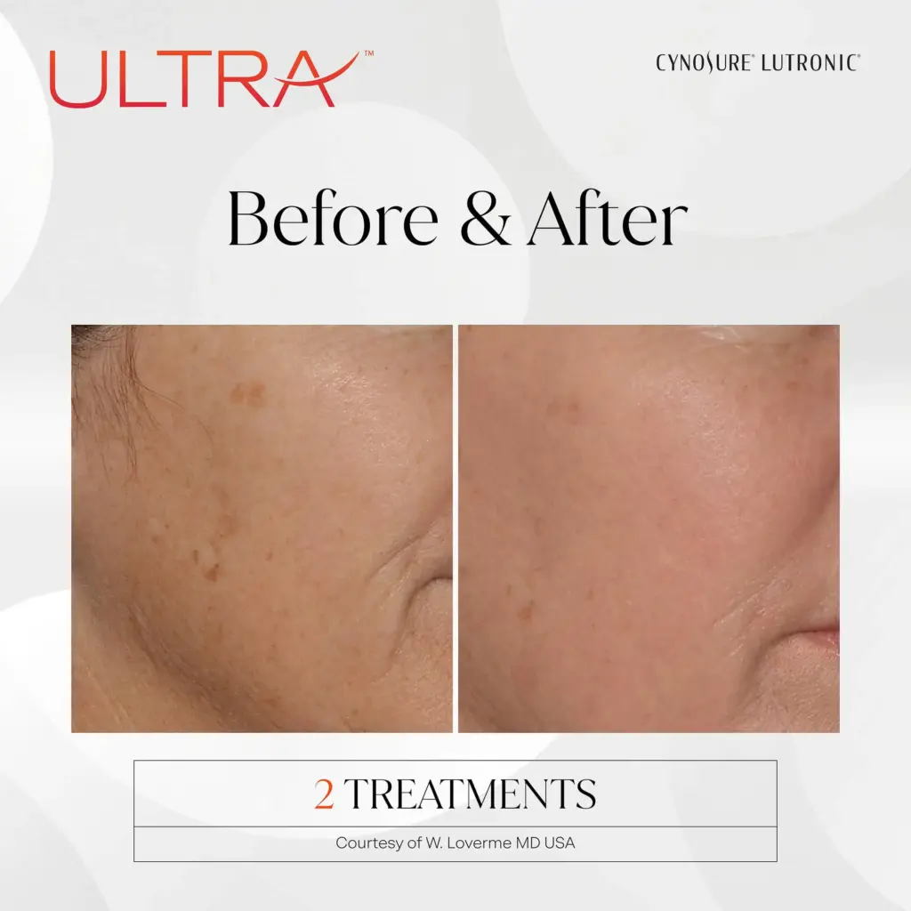 lasermd ultra before after one by medspa ca