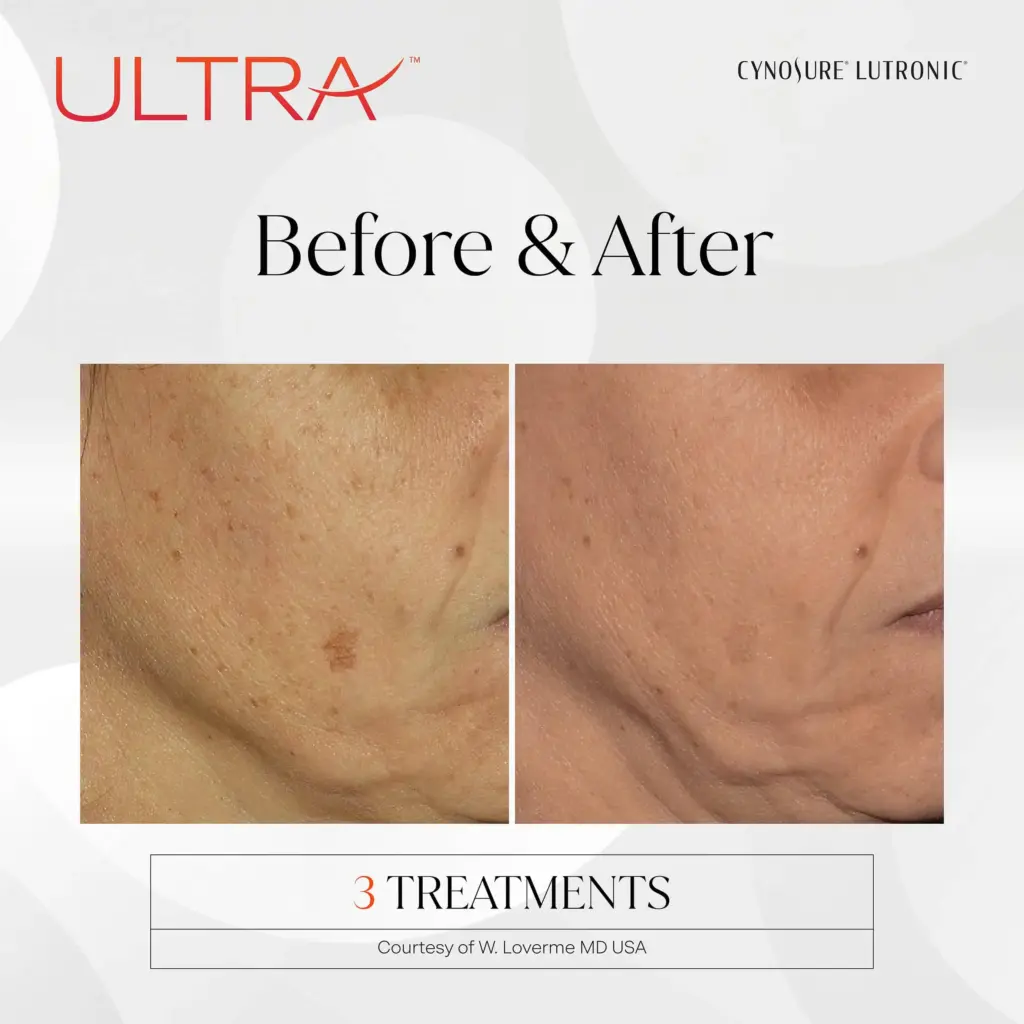 lasermd ultra before after three by medspa ca