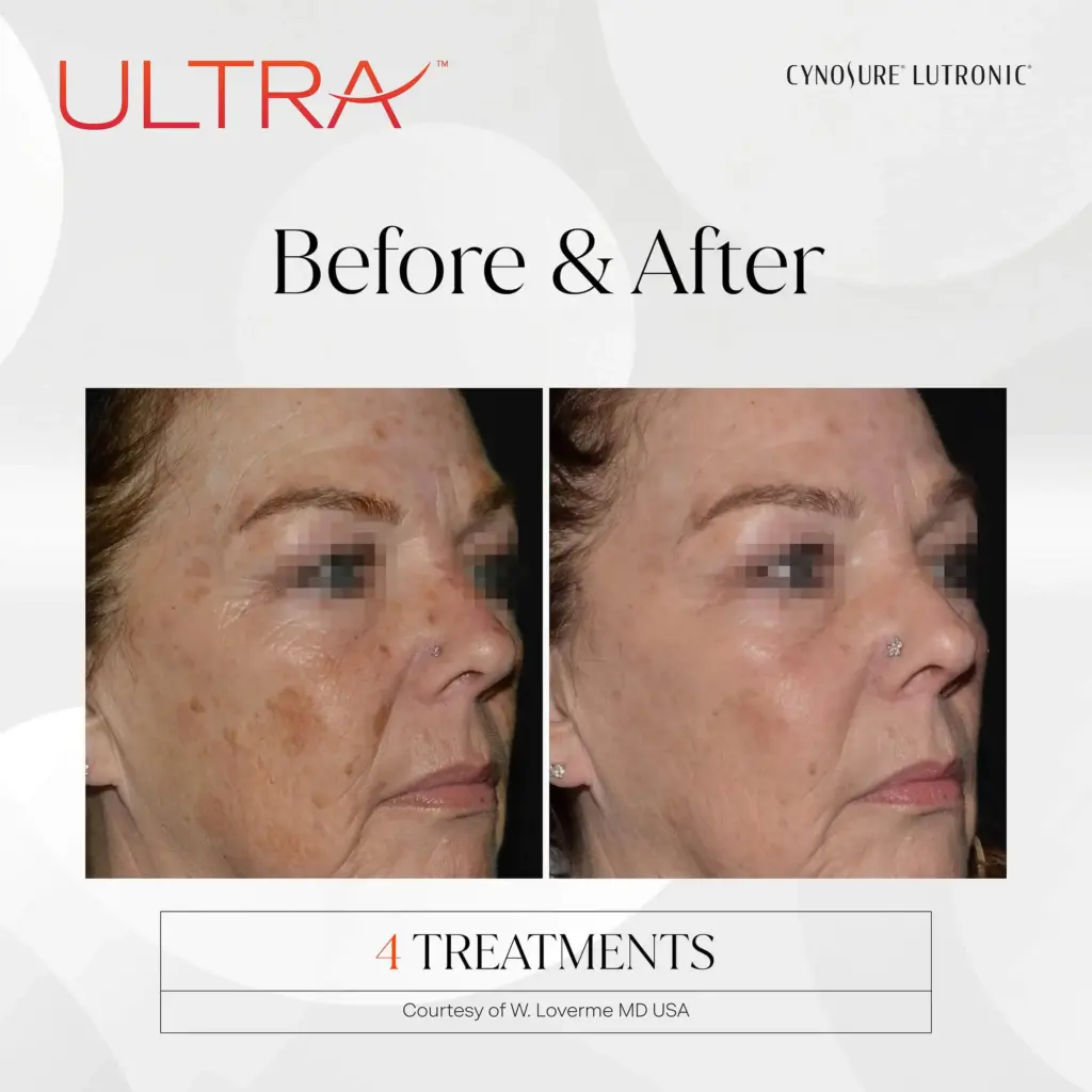 lasermd ultra before after two by medspa ca