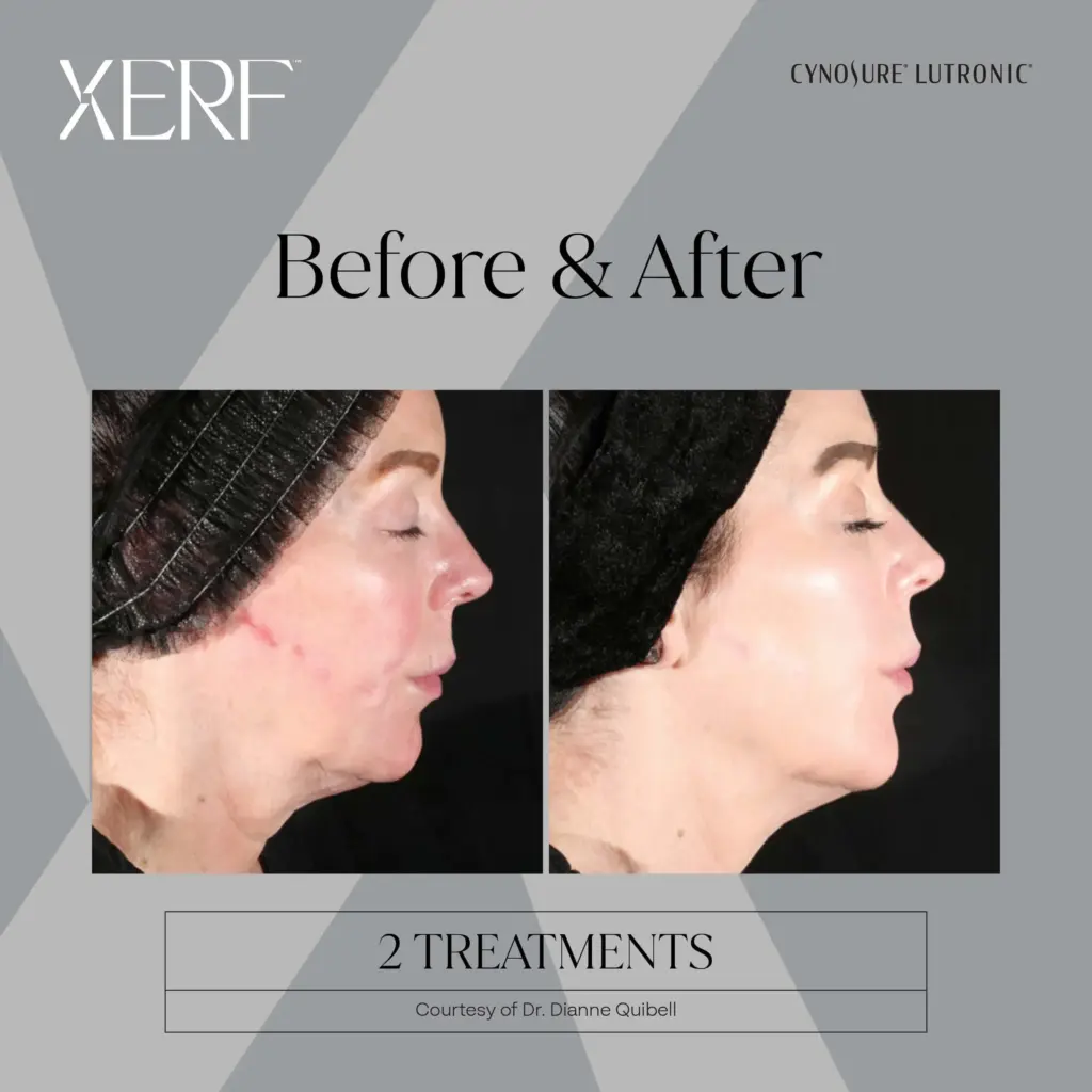 xerf before after five by medspa ca