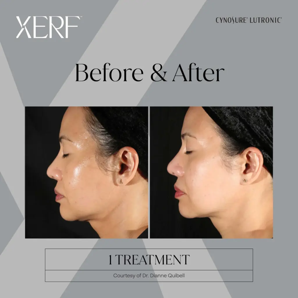 xerf before after four by medspa ca