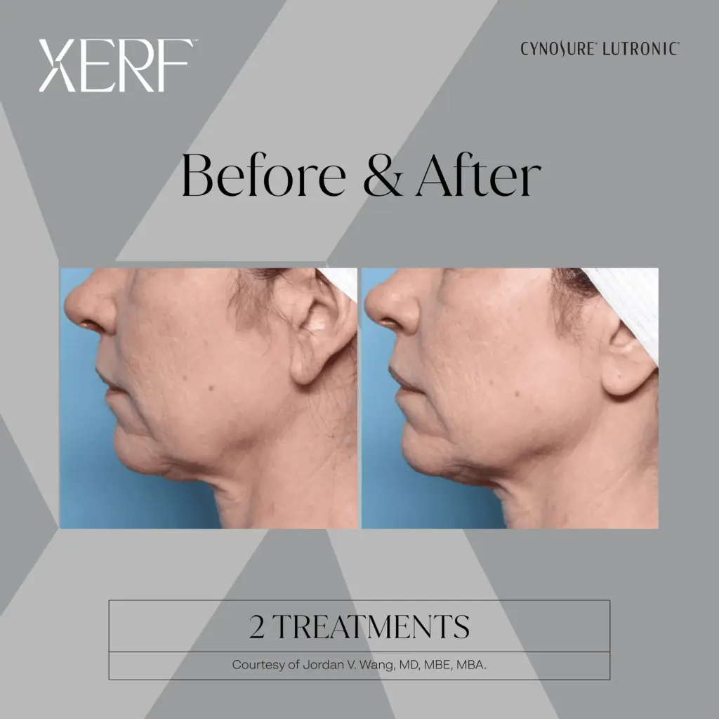 xerf before after one by medspa ca