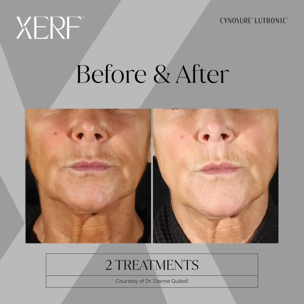 xerf before after six by medspa ca