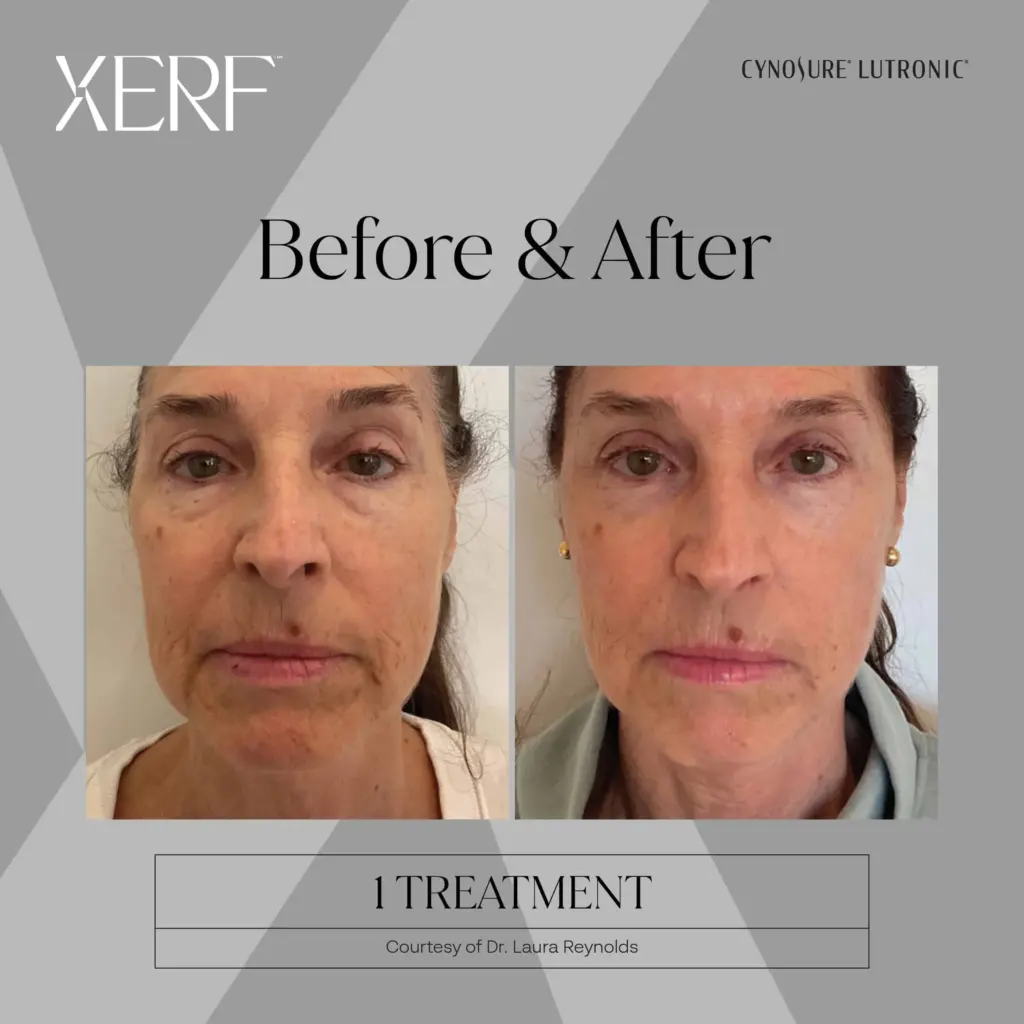 xerf before after three by medspa ca