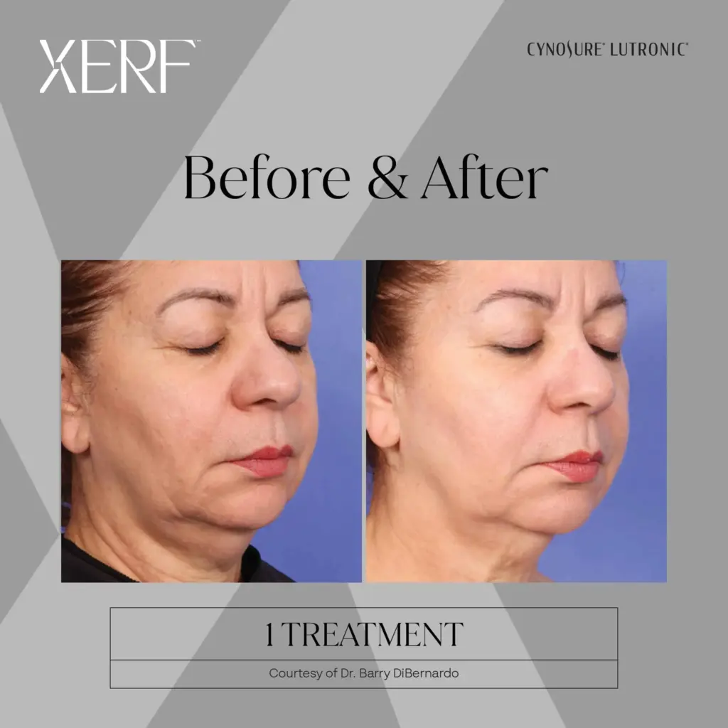 xerf before after two by medspa ca