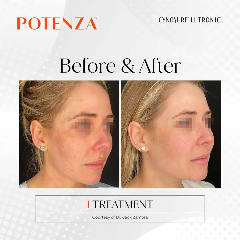 Potenza™ RF Microneedling