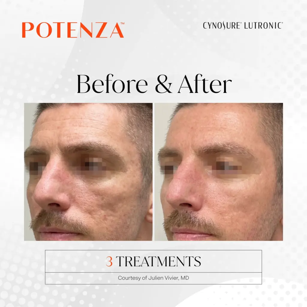 Potenza™ RF Microneedling
