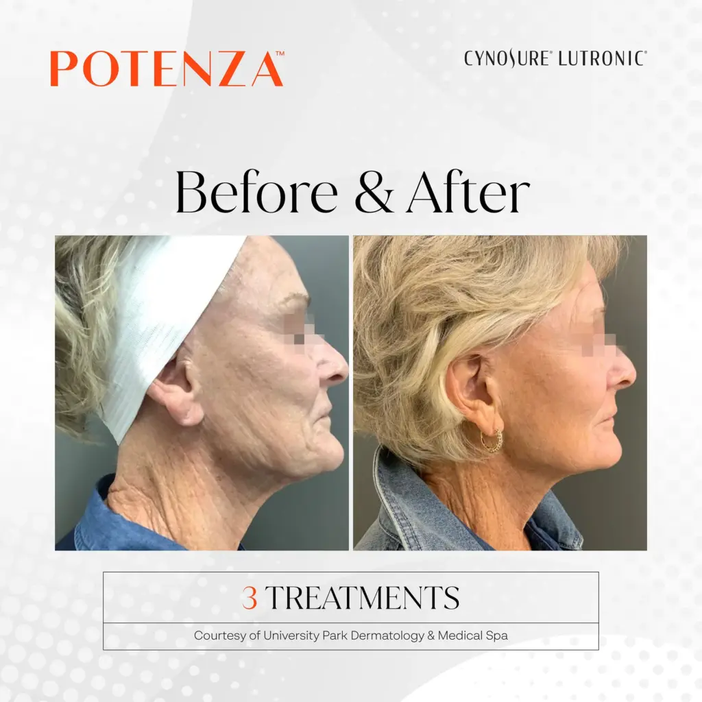 Potenza™ RF Microneedling