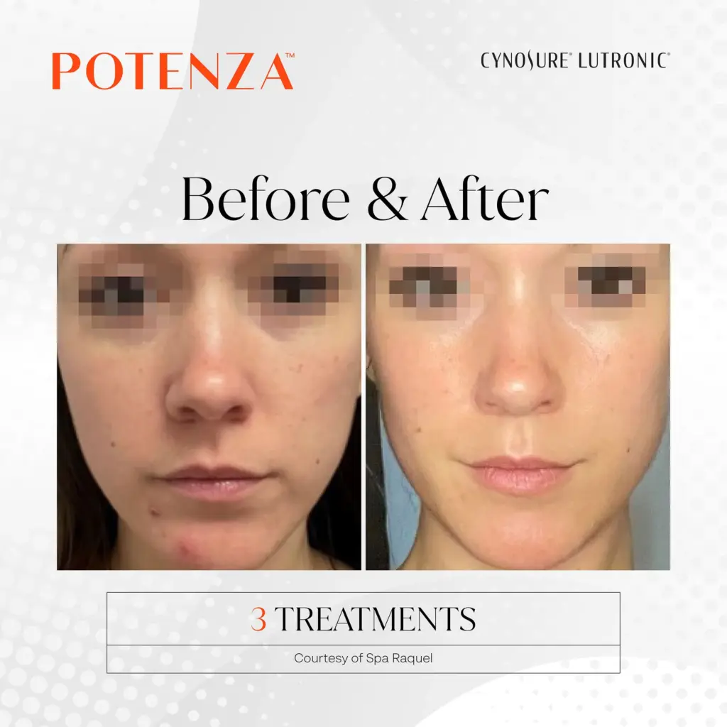 Potenza™ RF Microneedling