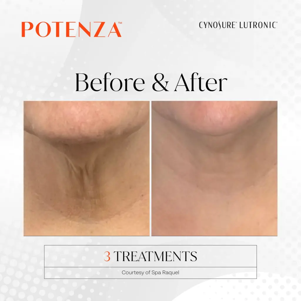 Potenza™ RF Microneedling