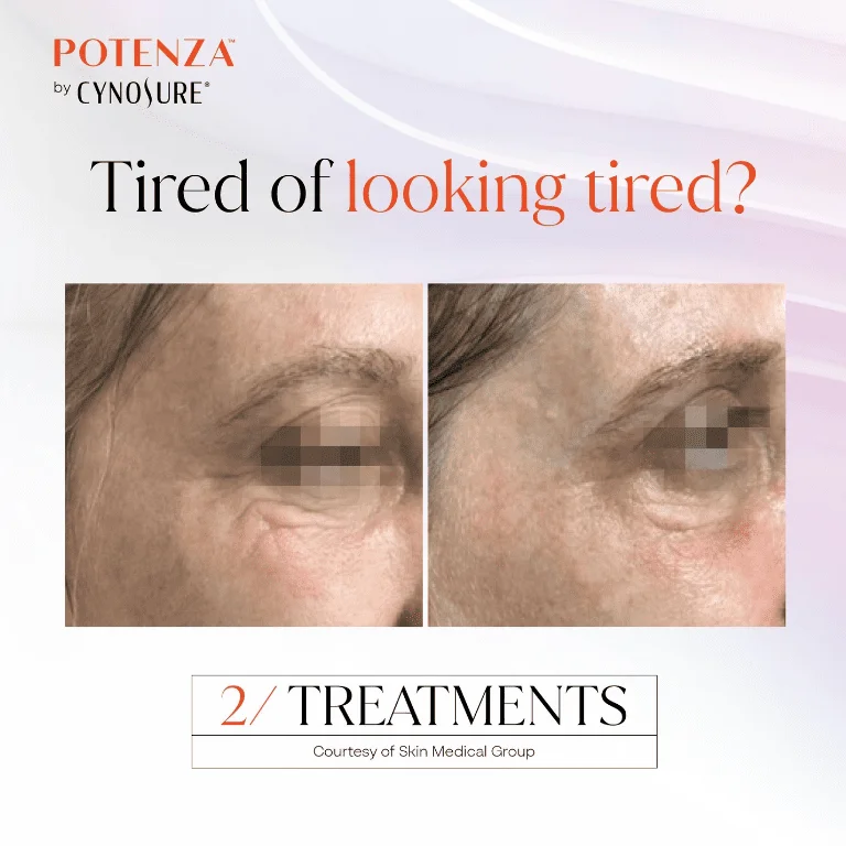 Potenza™ RF Microneedling