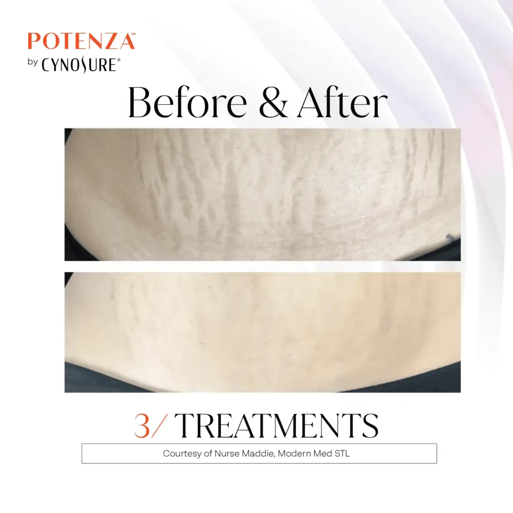 Potenza™ RF Microneedling